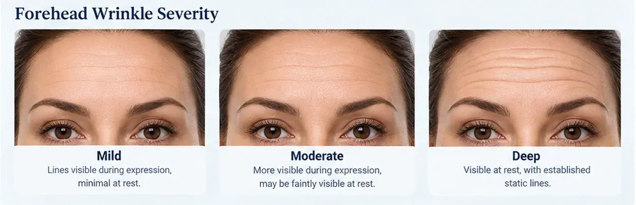 Forehead wrinkle severity: mild, moderate and deep horizontal lines