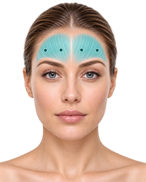 Front view highlighting four bilateral frontalis injection sites across the forehead