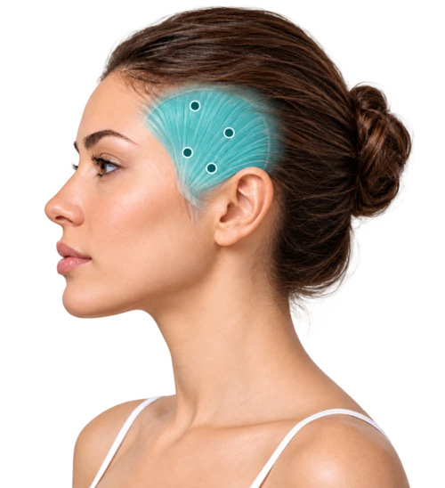 Side view highlighting the temporalis injection sites on the side of the head
